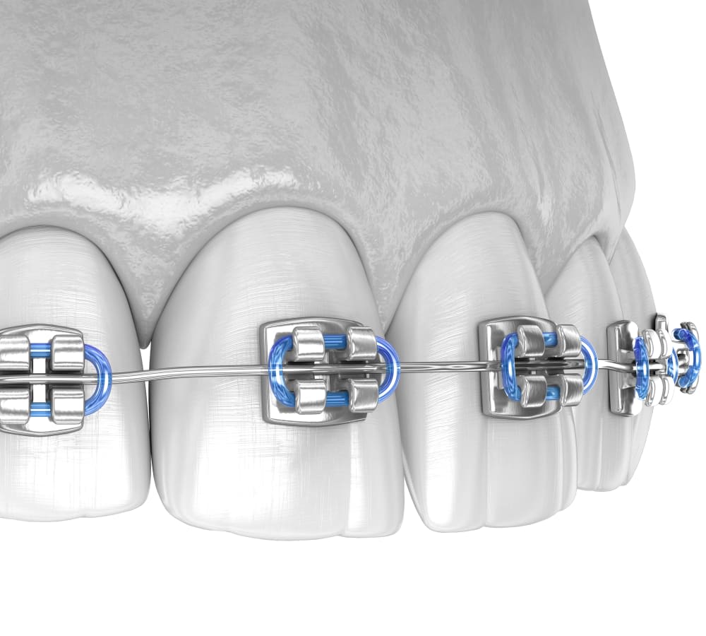 When someone chooses coloured braces, the coloured elastics bands can be switched out and customized however the patient chooses.