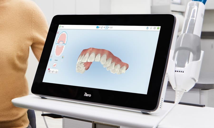 Screen shows digital impressions taken with iTero for Clear Aligners.